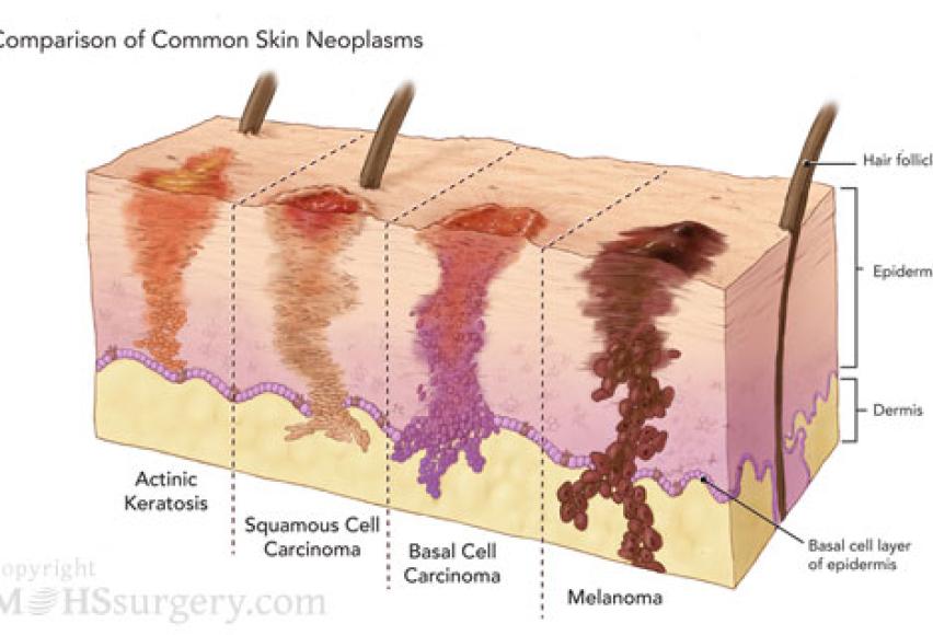 can-skin-picking-lead-to-skin-cancer-skinpick